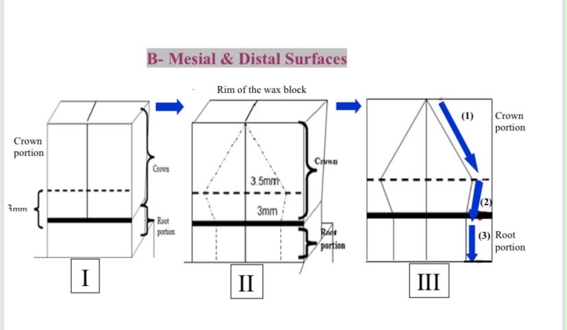 رسم توضيحي للأسطح الجانبية - Mesial & Distal Surfaces